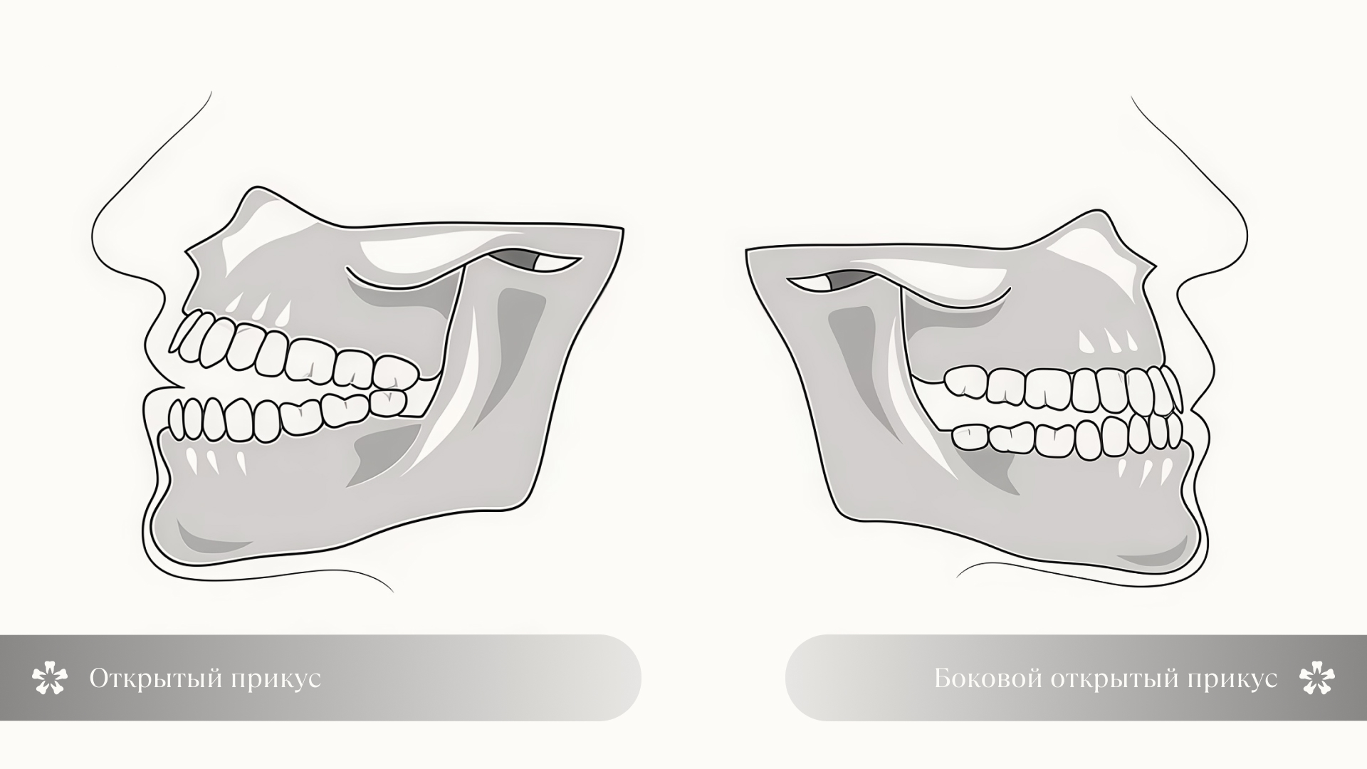 Схематичное изображение открытого и бокового открытого прикуса