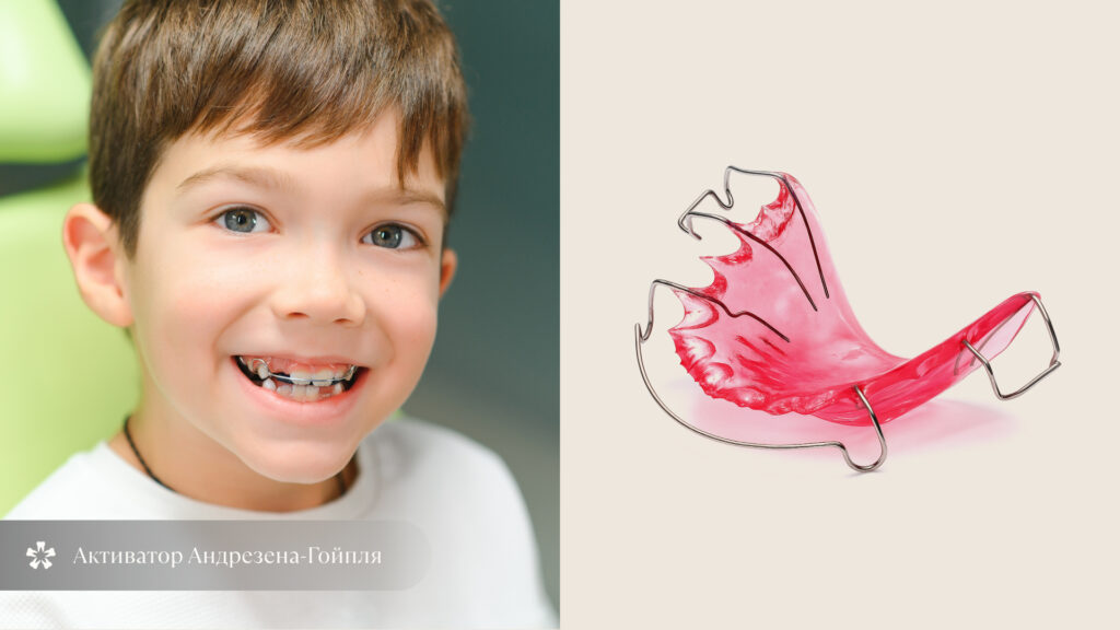 активатор Андрезена–Гойпля для исправления открытого прикуса, функциональный ортодонтический аппарат