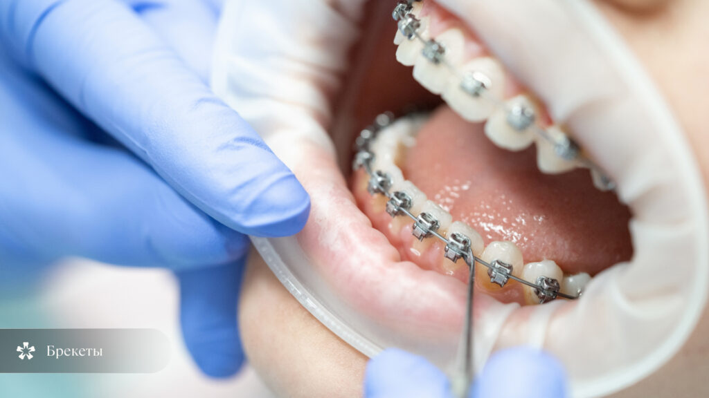 брекеты для исправления открытого прикуса у взрослых, ортодонтическая система на зубах
