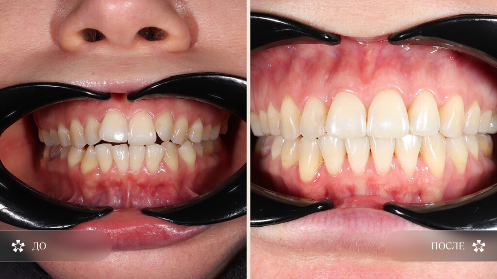 кейс исправления открытого прикуса элайнерами FlexiLigner у взрослого