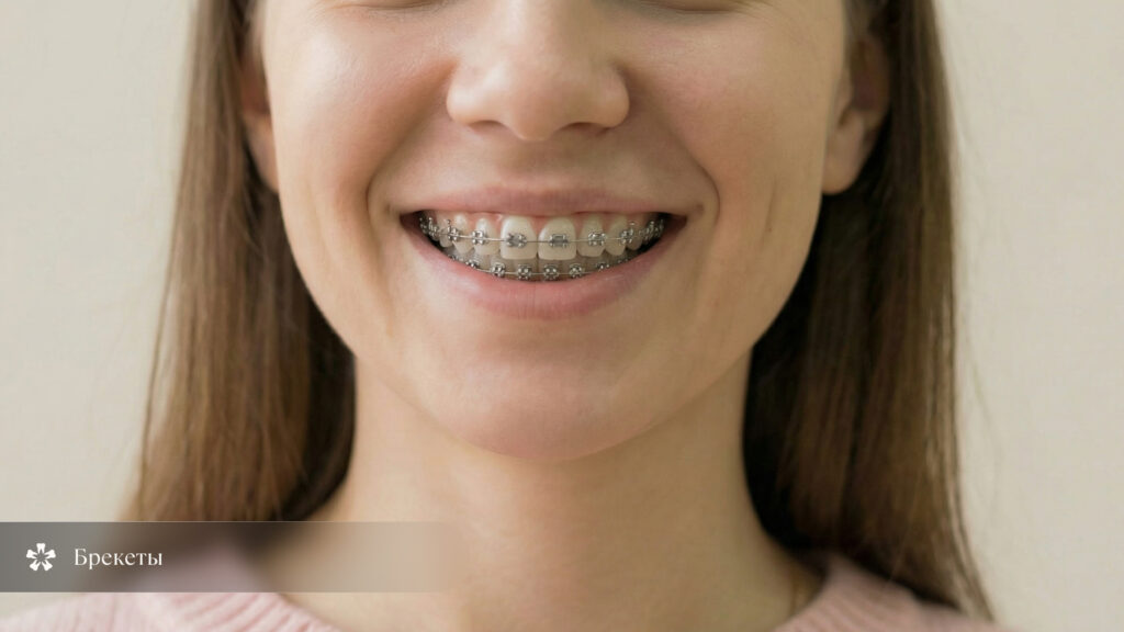 Нижняя часть лица девушки крупным планом, надпись «Брекеты» внизу слева