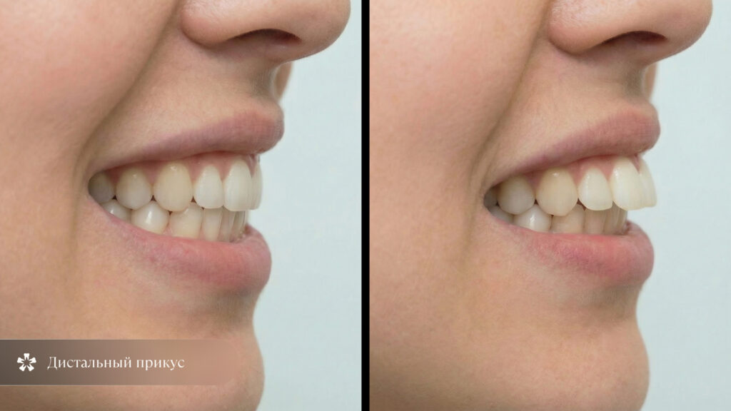 Улыбка женщины в профиль с дистальным прикусом крупным планом 