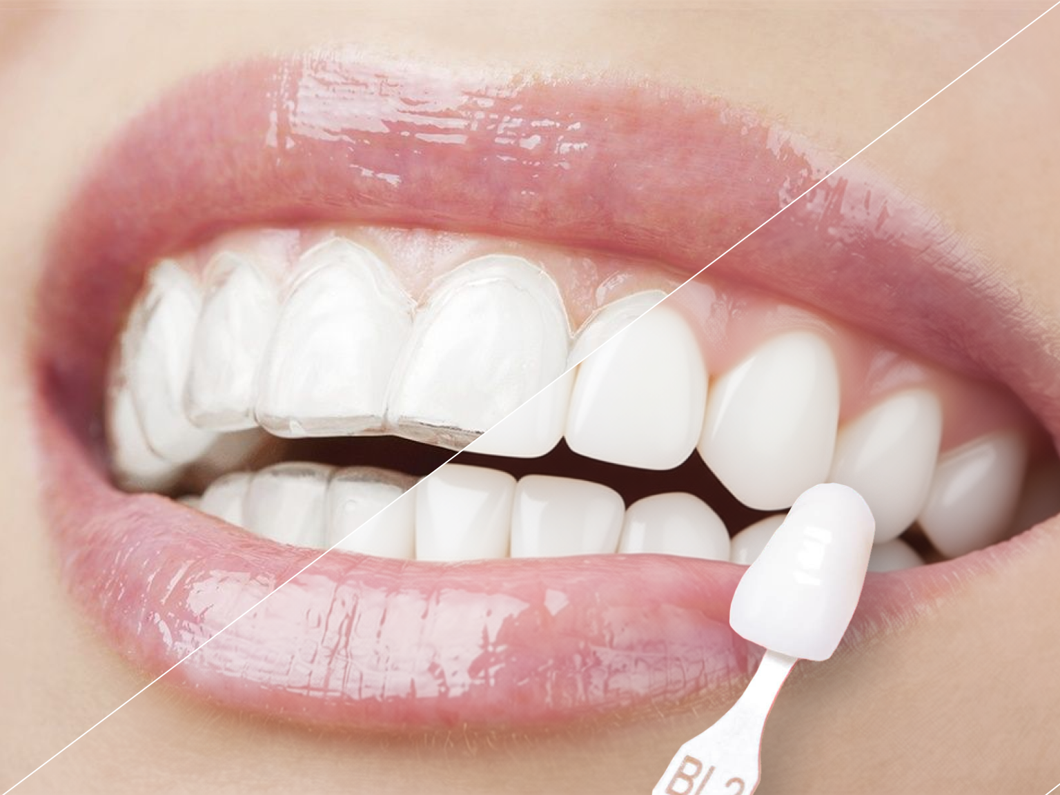 Элайнеры или виниры, изображение показывает наглядную разницу